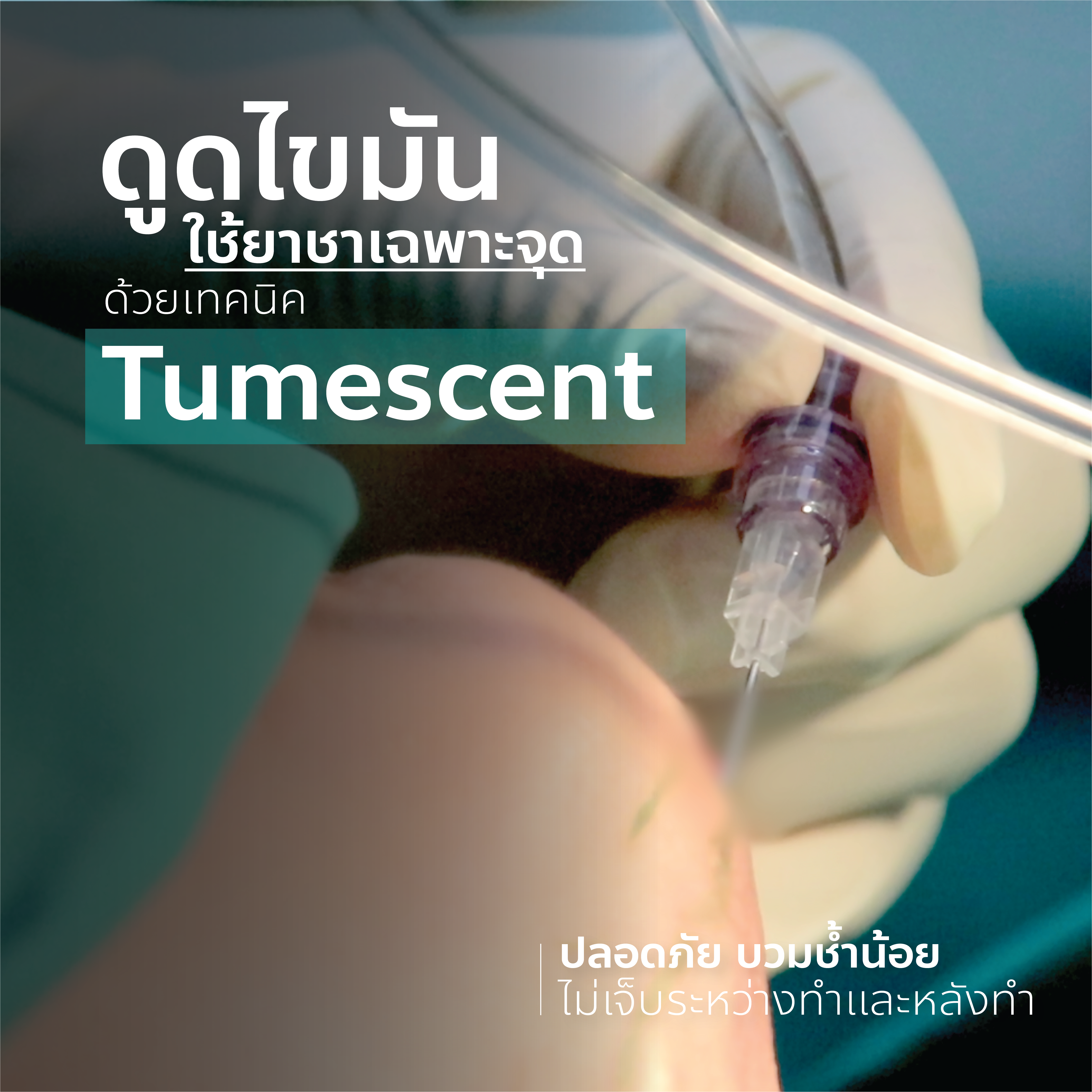 ดูดไขมันไม่เจ็บ ด้วยเทคนิคการให้ยาชา Tumescent