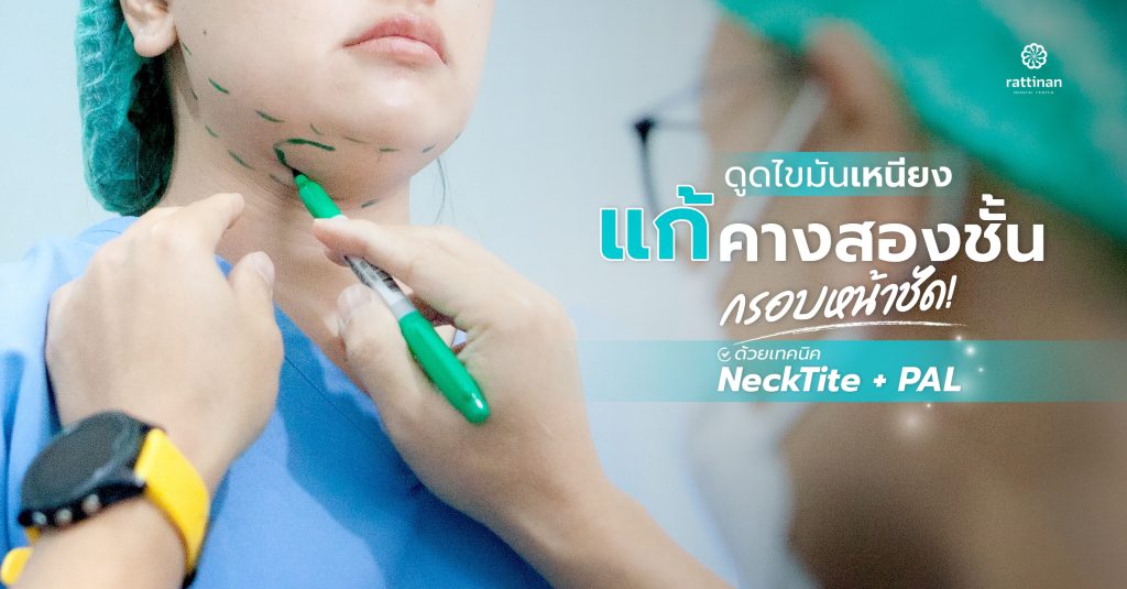 ดูดไขมันเหนียง คางสองชั้น เทคนิคใหม่ แผลเล็ก เจ็บน้อย (Chin Liposuction)