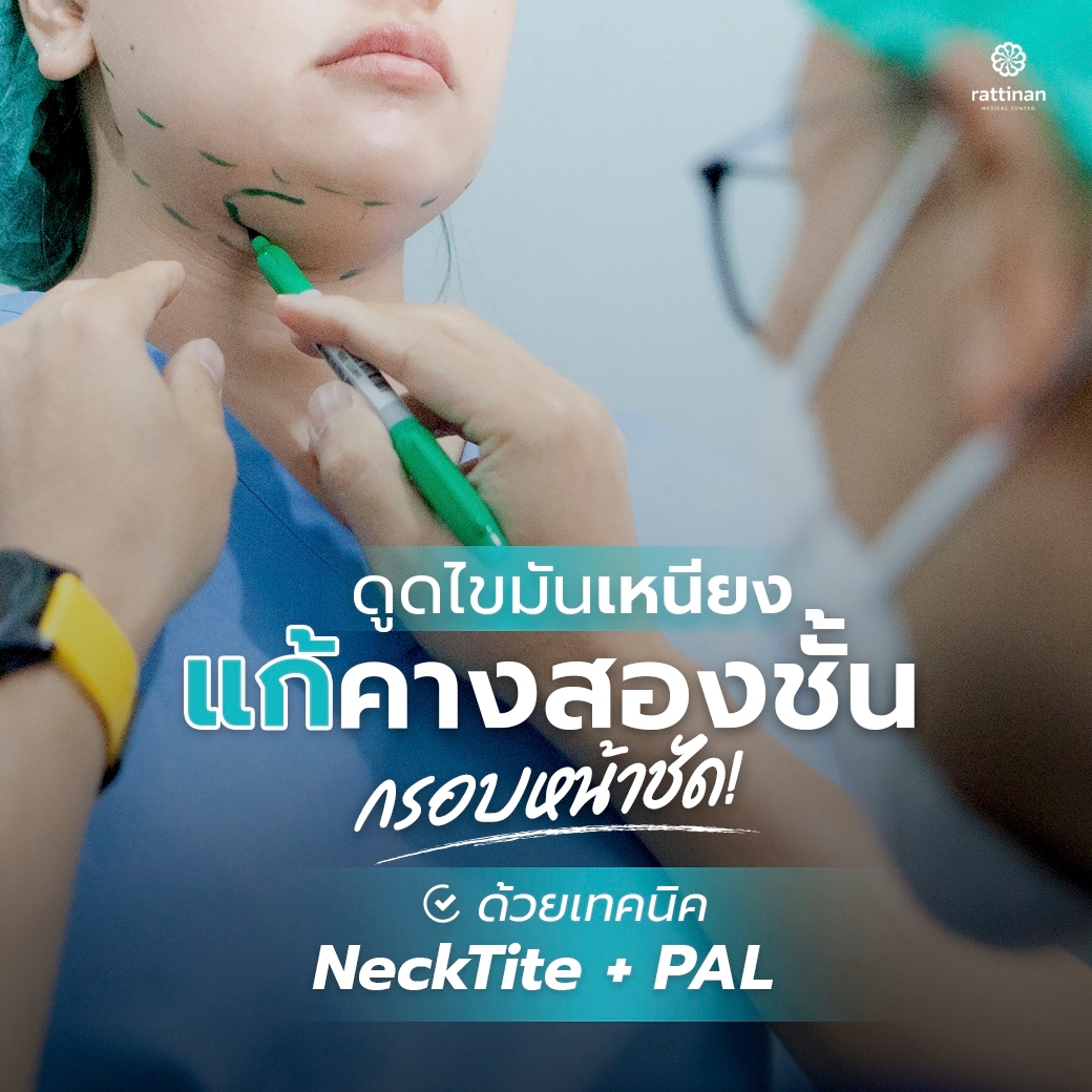 ดูดไขมันเหนียง
