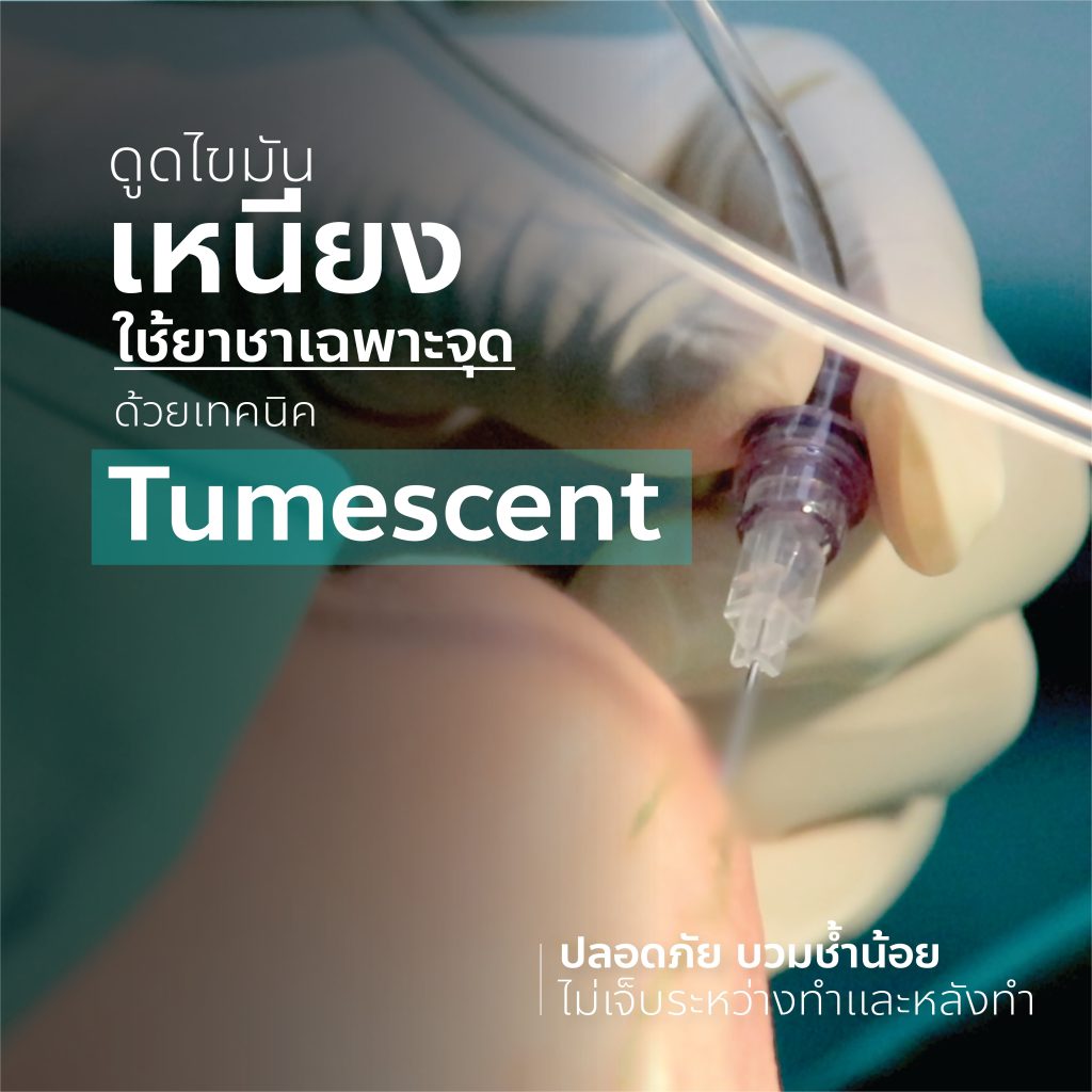 ยาชาเฉพาะจุด Tumescent