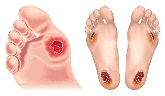 โรคเบาหวาน แผลกดทับ แผลเรื้องรัง รักษาด้วย PRP Therapy