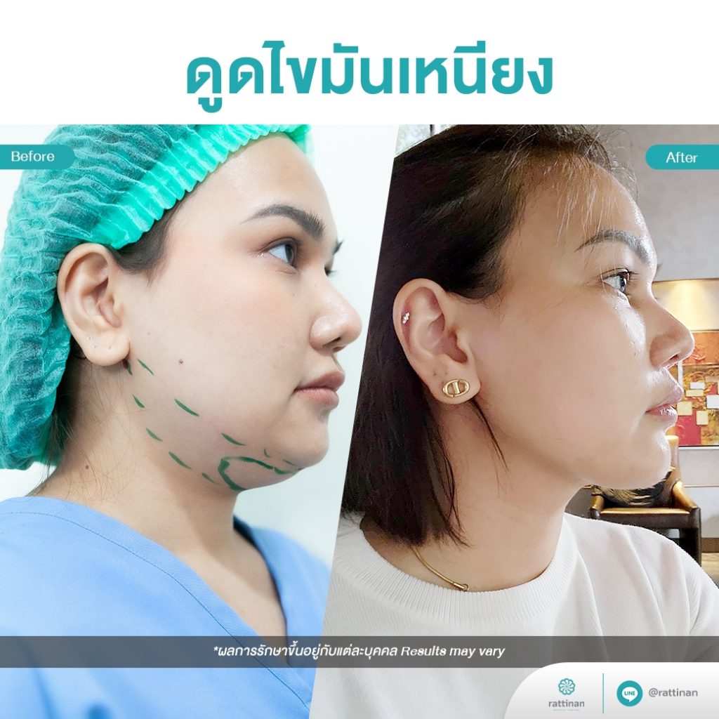 รีวิว ดูดไขมันใต้คาง ดูดไขมันเหนัยง (Chin Liposuction)