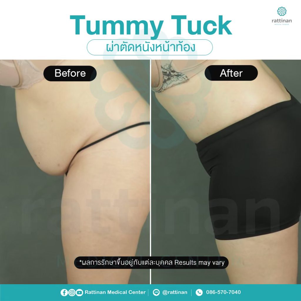 รีวิว ตัดหนังหน้าท้อง แบบ full tummy tuck