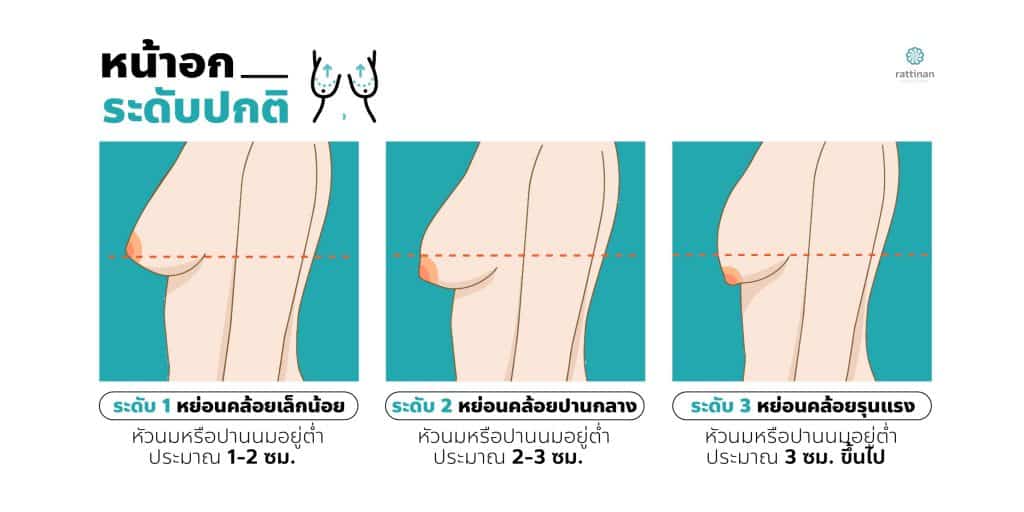 ระดับความหย่อนคล้อยของหน้าอกผู้หญิง