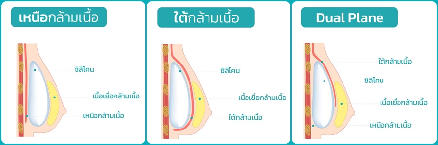 เทคนิคการเสริมหน้าอก เหนื่อกล้ามเนื้อ ใต้กล้ามเนื้อ ระหว่างกล้ามเนื้อ