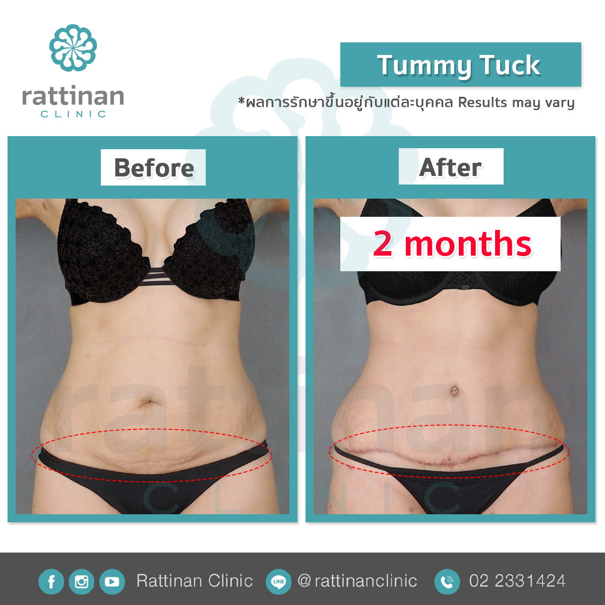 รีวิว ตัดหนังหน้าท้อง - mini tummy tuck รัตตินันท เมดิคอล เซ็นเตอร์