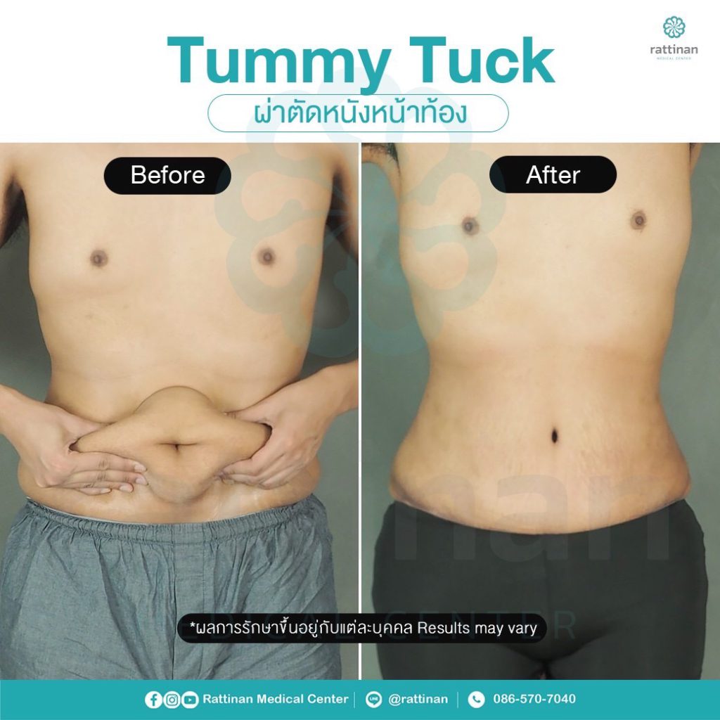 รีวิว ตัดหนังหน้าท้อง แบบ full tummy tuck รัตตินันท เมดิคอล เซ็นเตอร์