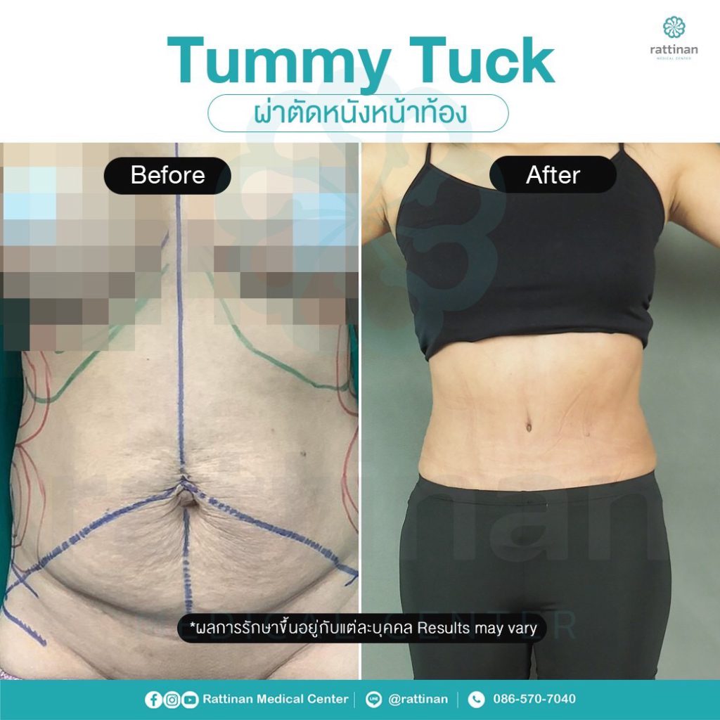 รีวิว ตัดหนังหน้าท้อง แบบ full tummy tuck รัตตินันท เมดิคอล เซ็นเตอร์