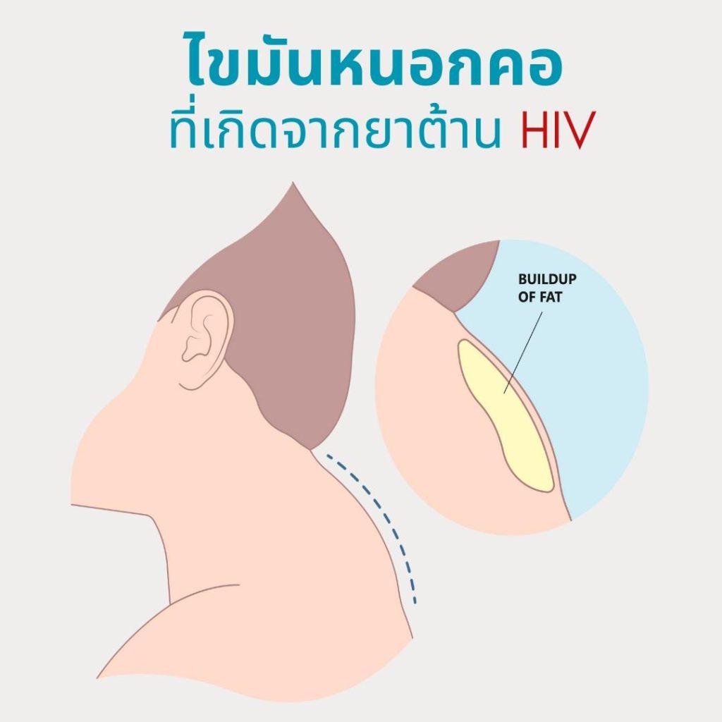 buffalo hump ดูดไขมันหนอกคอ เกิดจาก ยาต้าน HIV