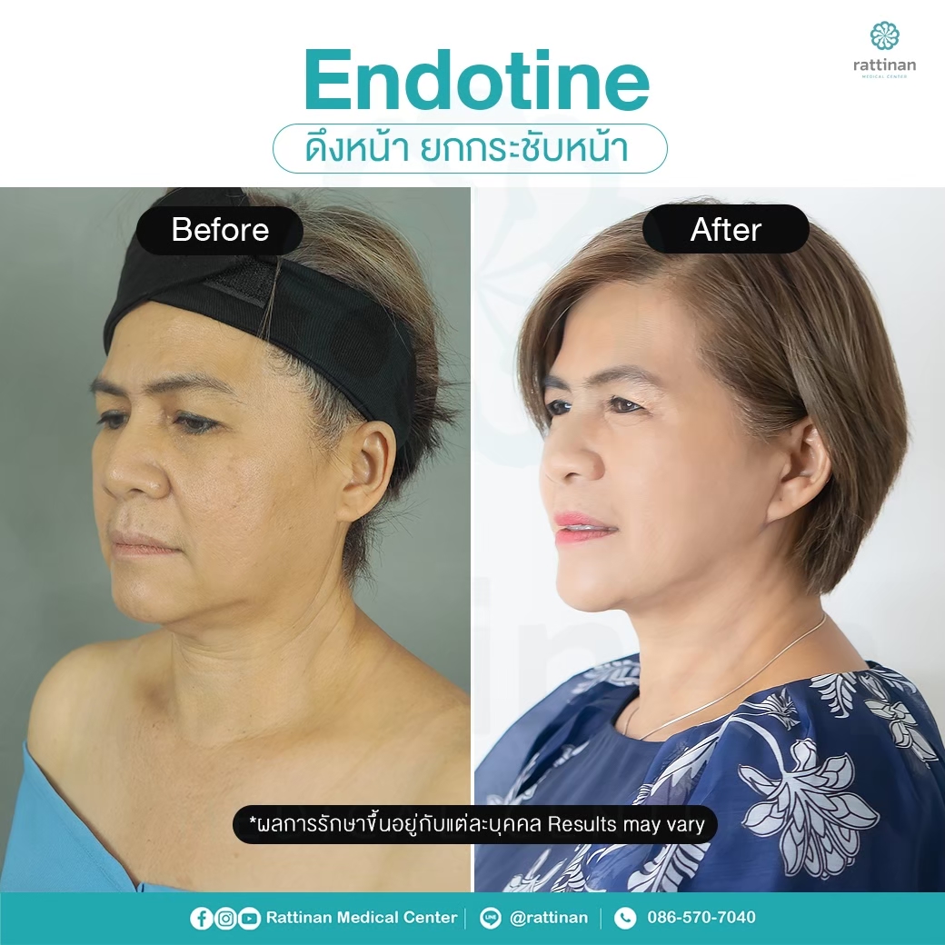 รีวิว ศัลยกรรมดึงหน้า แก้ปํญหาใบหน้าส่วนกลางและใบหน้าส่วนล่าง