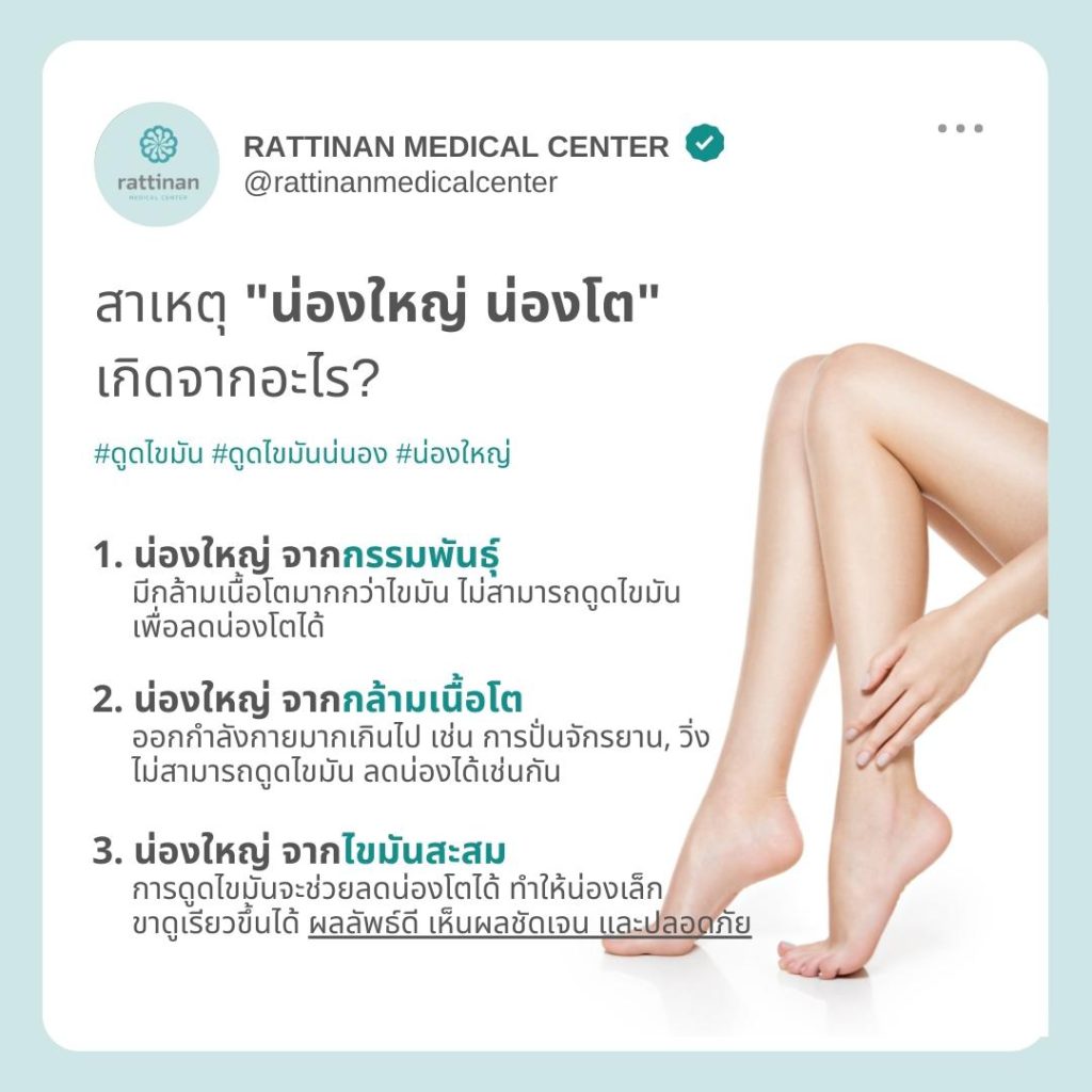 น่องใหญ่ น่องโต เกิดจากอะไร? ดูดไขมันน่องได้ไหม?