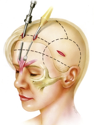 ศัลยกรรมดึงหน้า วิธีดึงหน้าแบบผ่าตัดผ่านกล้อง (Endoscopic Face Lift)