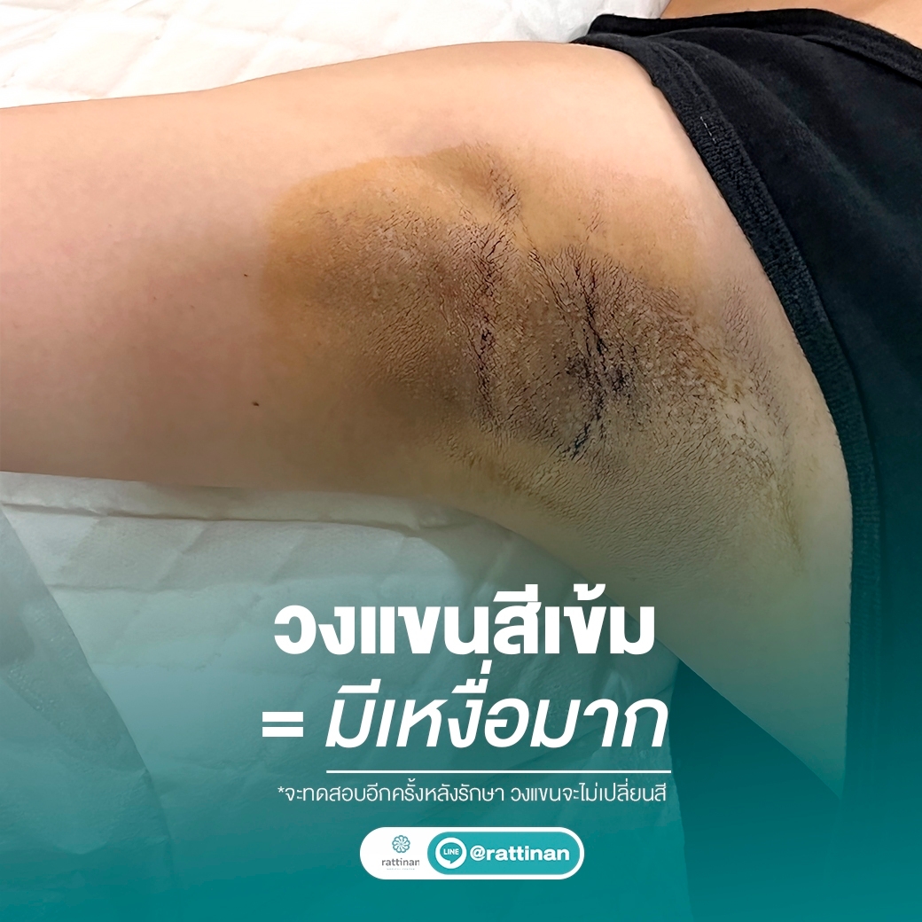 ทดสอบเหงื่อ miraDry