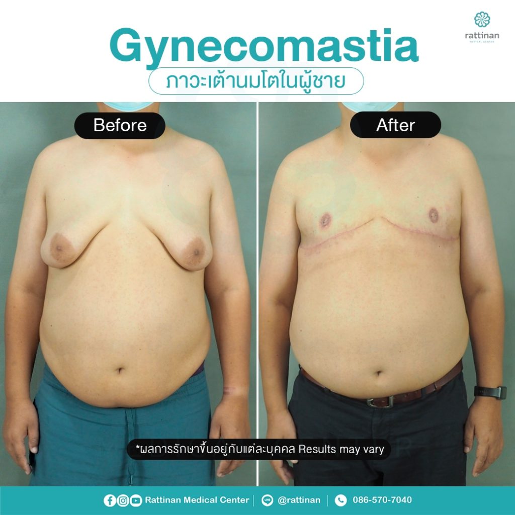 รีวิว รักษาเต้านมโตในผู้ชาย ผู้ชายนมแหลม - Gynecomastia ร่วมกับผ่าตัดหน้าอก