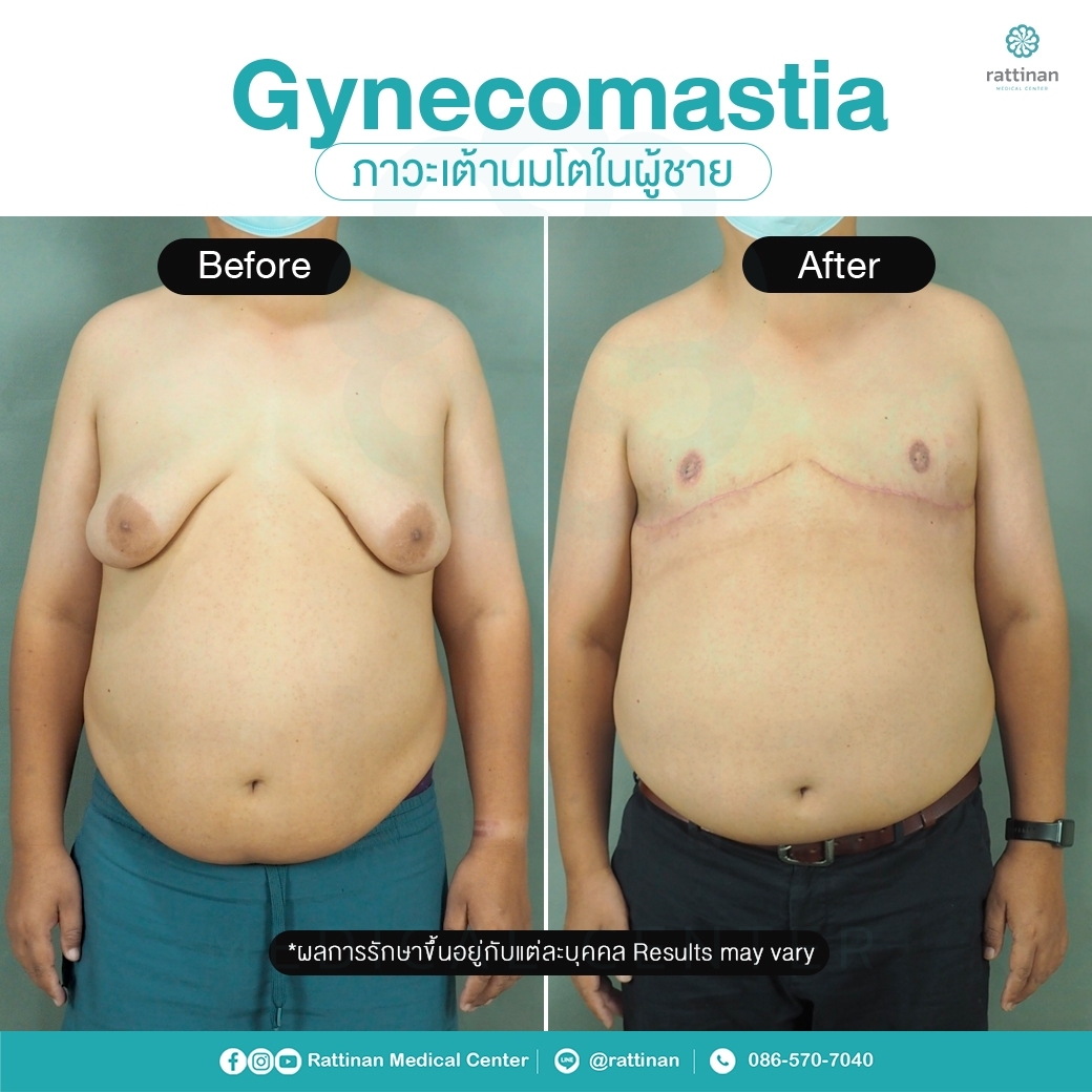 รีวิว รักษาเต้านมโตในผู้ชาย ผู้ชายนมแหลม - Gynecomastia ร่วมกับผ่าตัดหน้าอก