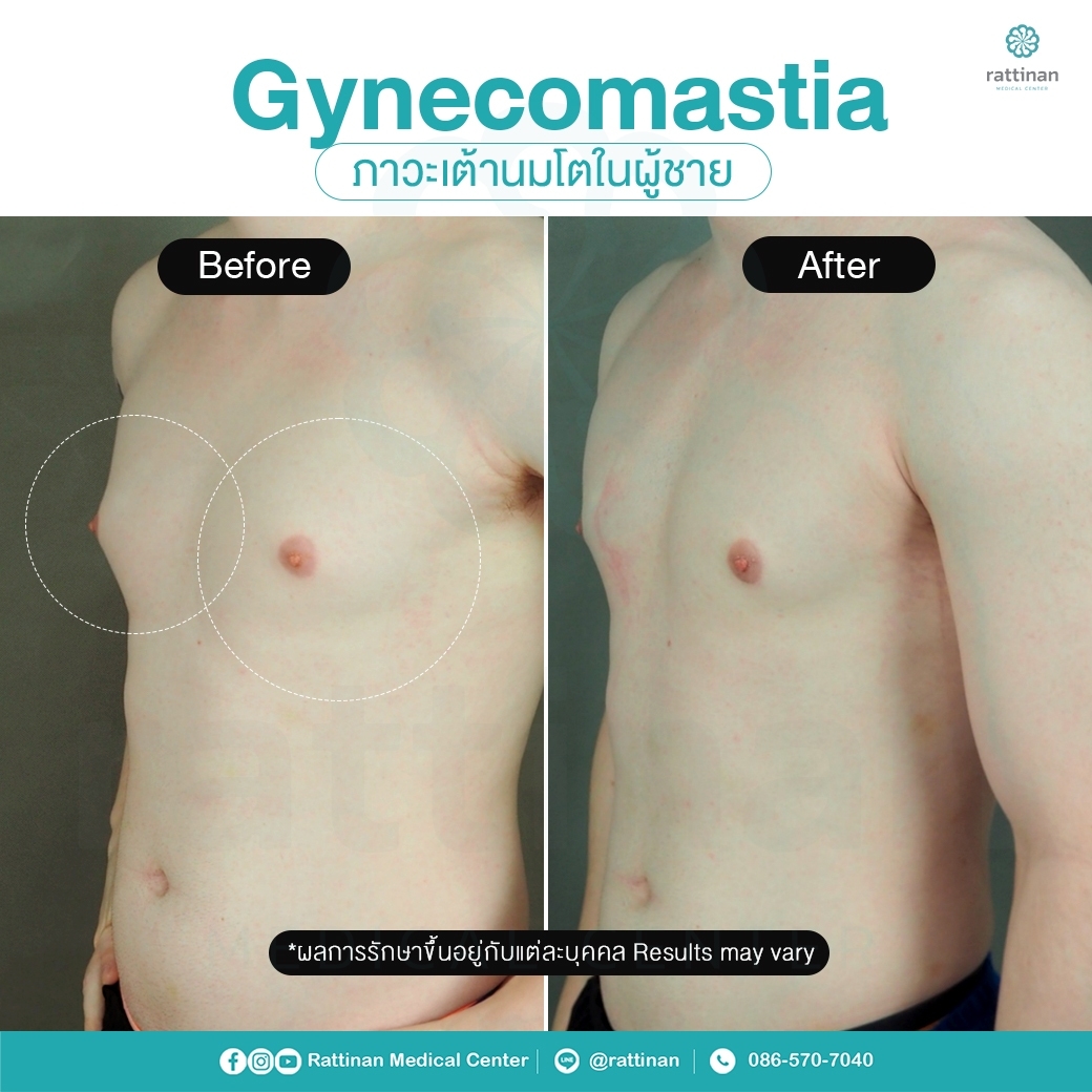 รีวิว รักษาเต้านมโตในผู้ชาย ผู้ชายนมแหลม - Gynecomastia 5