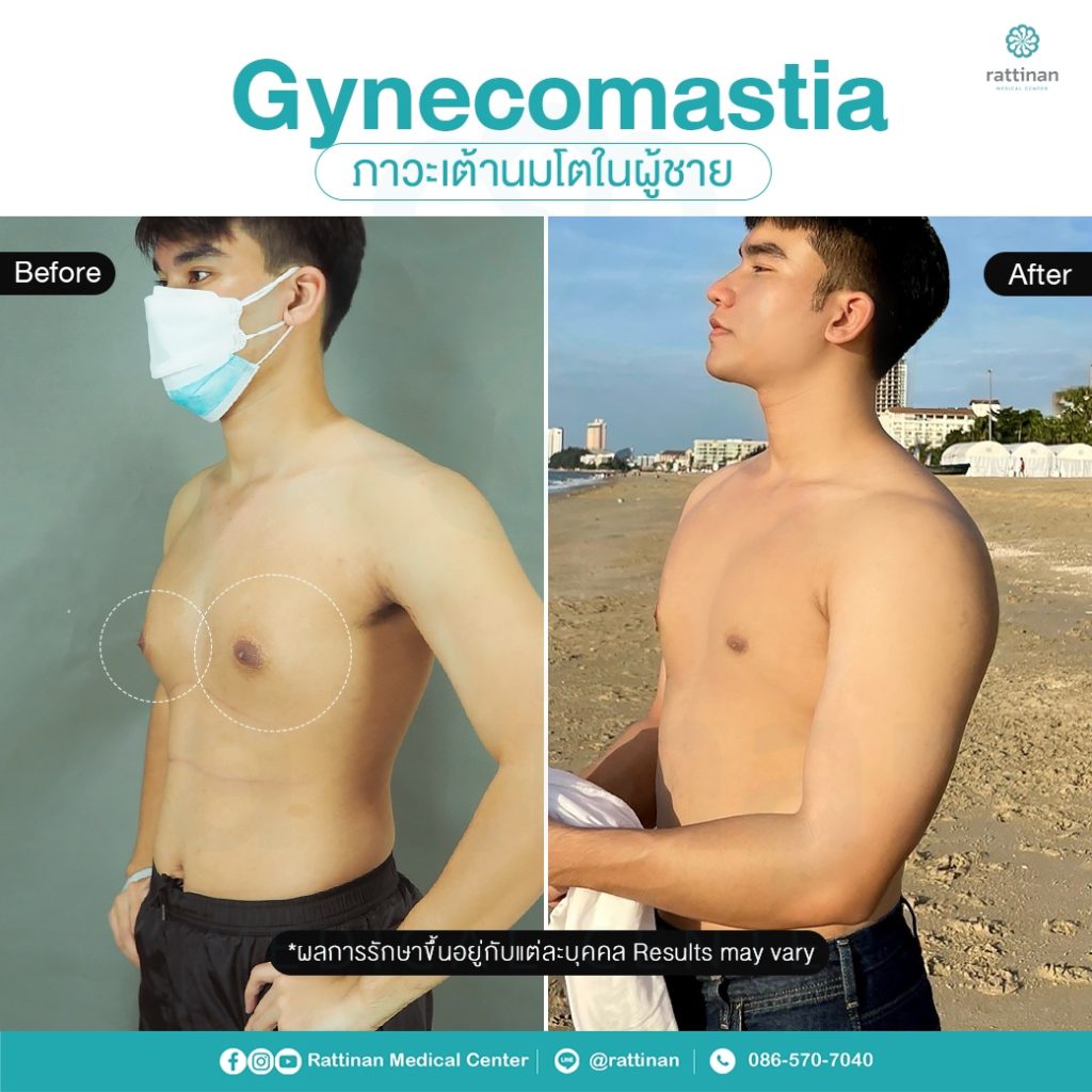 รีวิว รักษาเต้านมโตในผู้ชาย ผู้ชายนมแหลม - Gynecomastia 6