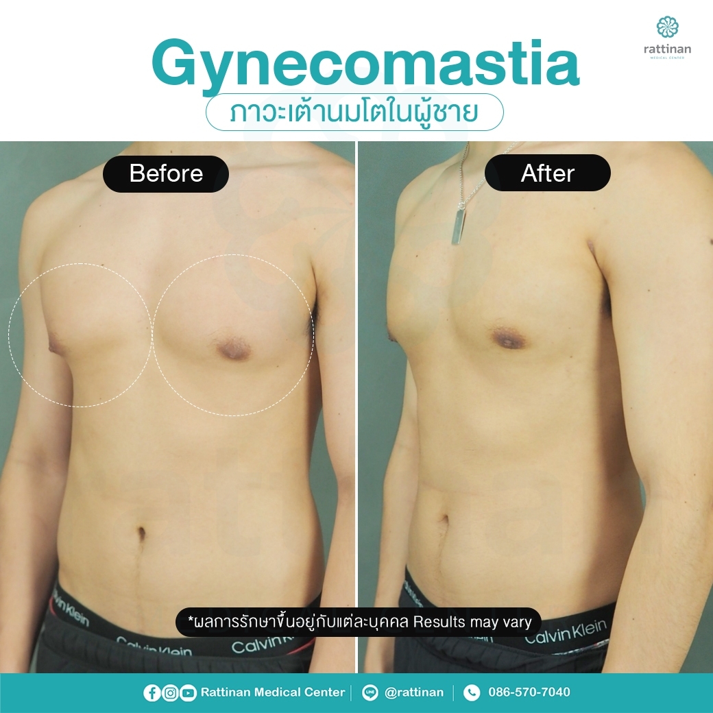 รีวิว รักษาเต้านมโตในผู้ชาย ผู้ชายนมแหลม - Gynecomastia 7