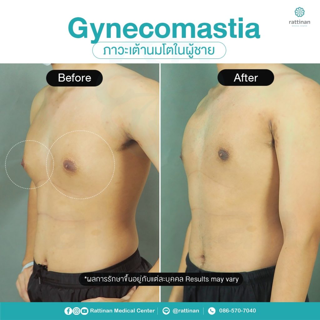 รีวิว รักษาเต้านมโตในผู้ชาย ผู้ชายนมแหลม - Gynecomastia