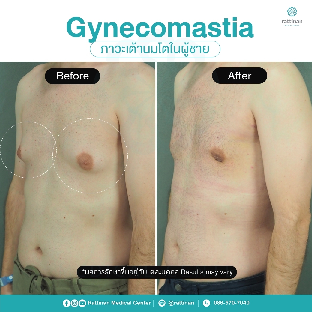 รีวิว รักษาเต้านมโตในผู้ชาย ผู้ชายนมแหลม - Gynecomastia 2