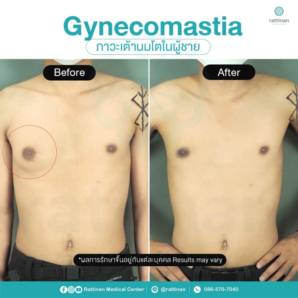 รีวิว รักษาเต้านมโตในผู้ชาย ผู้ชายนมแหลม - Gynecomastia 3