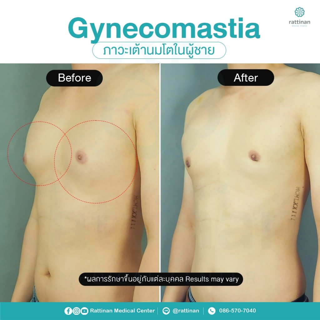 รีวิว รักษาเต้านมโตในผู้ชาย ผู้ชายนมแหลม - Gynecomastia 4