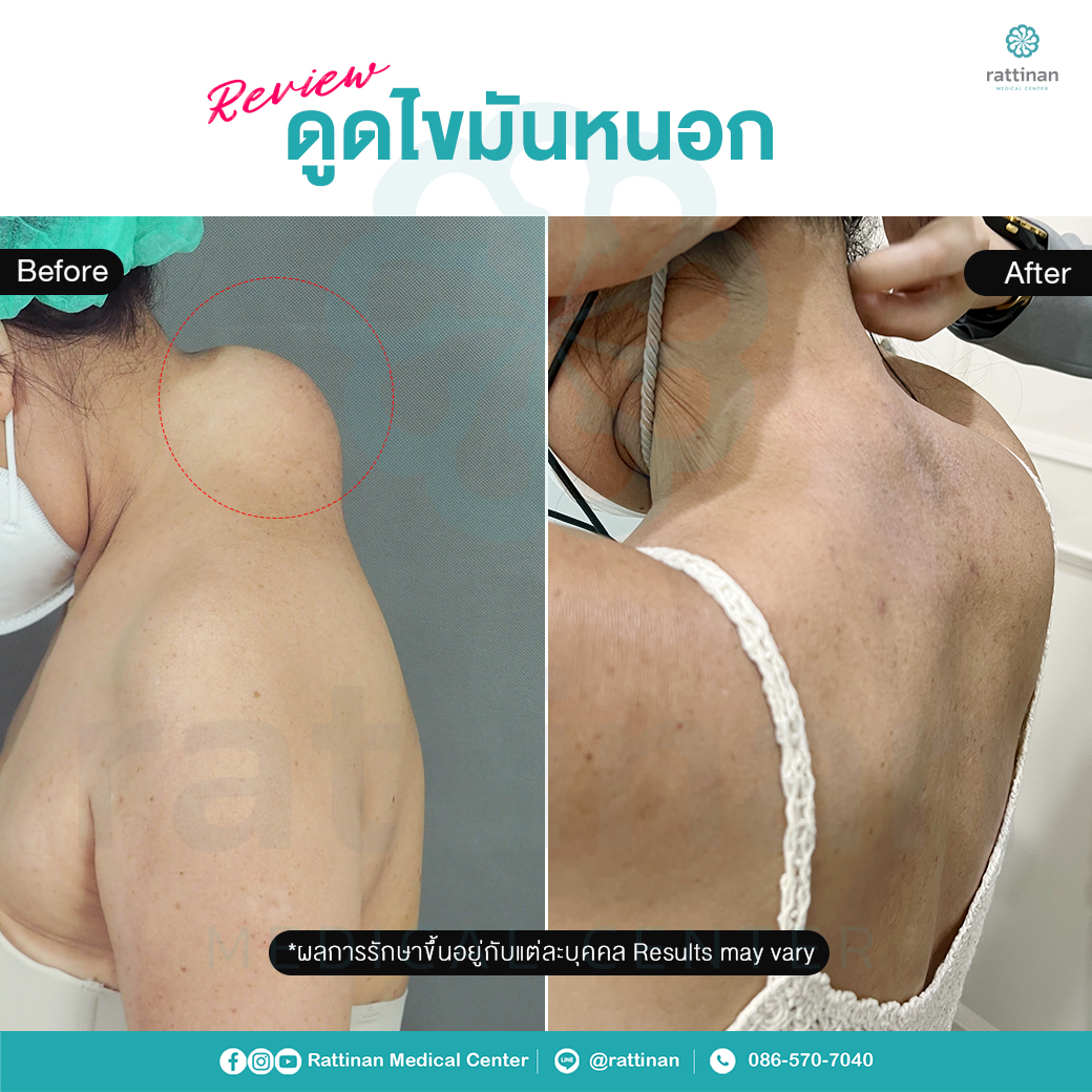 รีวิวดูดไขมันหนอกคอ - buffalo hump liposuction