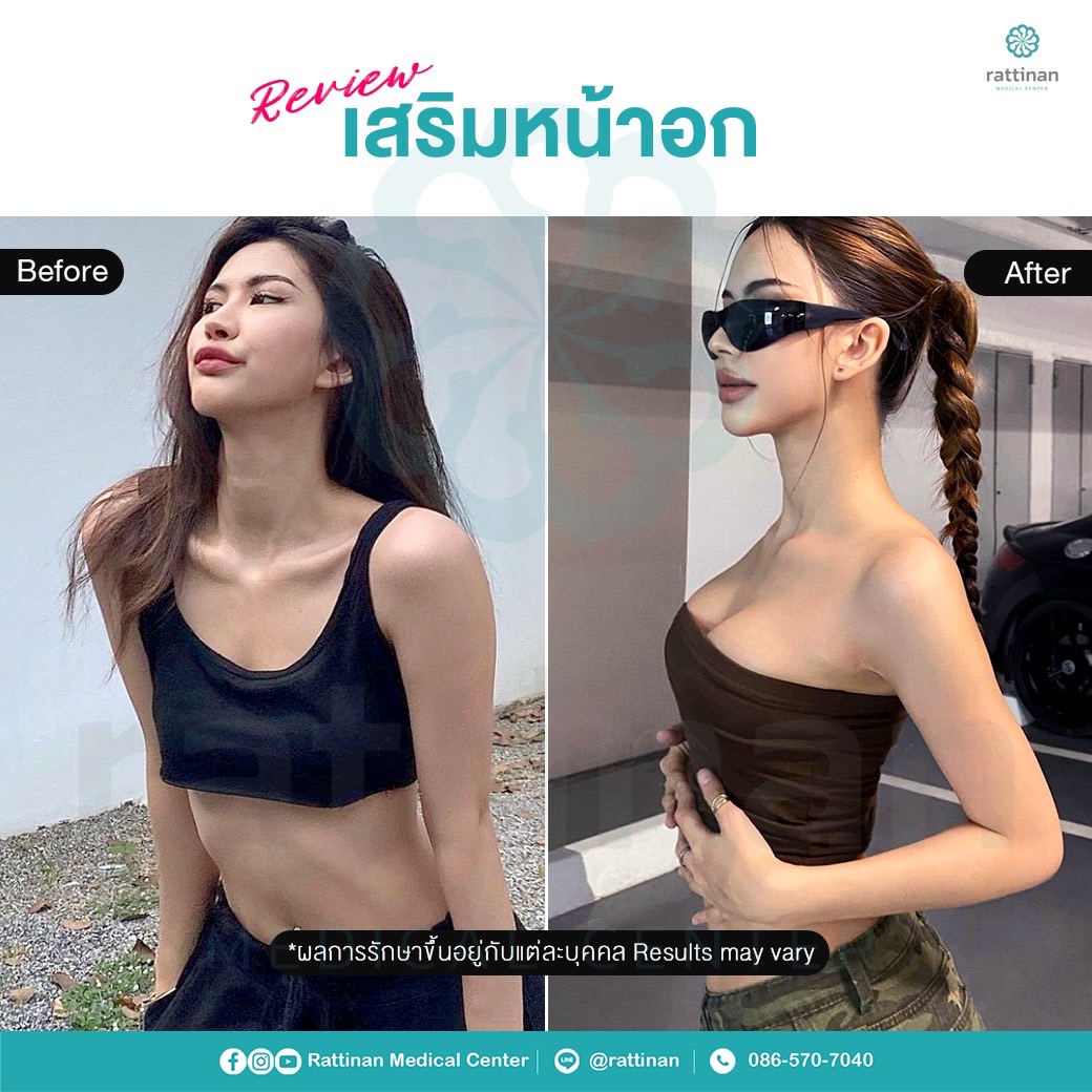 รีวิวเสริมหน้าอก เสริมนม เทคนิคใหม่ ที่รัตตินันท์ เมดิคอล เซ็นเตอร์