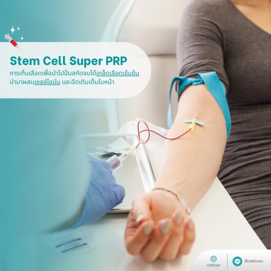 Stem Cell Super PRP การเก็บเลือดเพื่อนำไปปั่นสกัดจนได้เกล็ดเลือดเข้มข้น นำมาผสมเซลล์ไขมัน และฉีดเติมเต็มใบหน้า