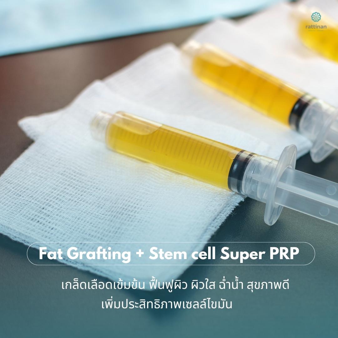 ใส่ stem cell suprt prp พร้อมกับการเติมไขมันหน้าเด็ก (ฉีดไขมันหน้า)