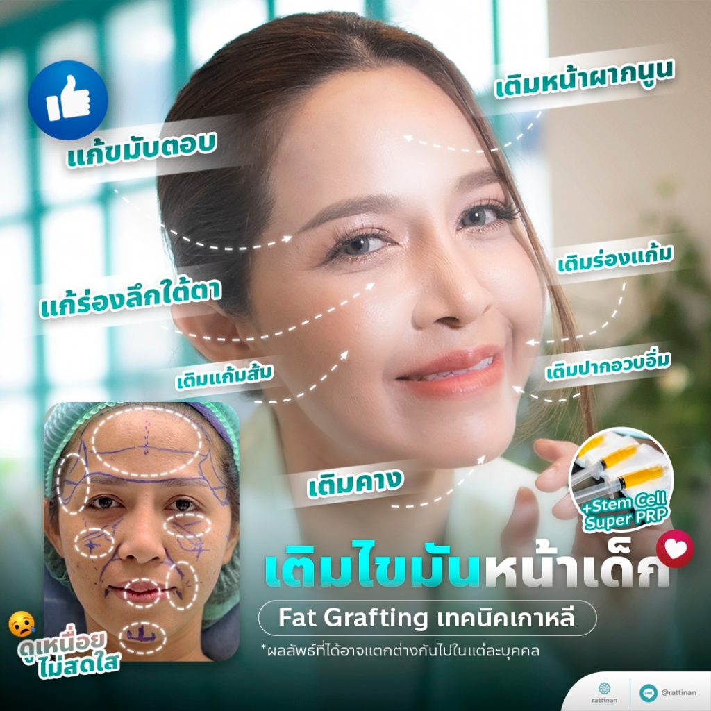 fat grafting ฉีดไขมันหน้า รีวิวเติมไขมันหน้าเด็ก