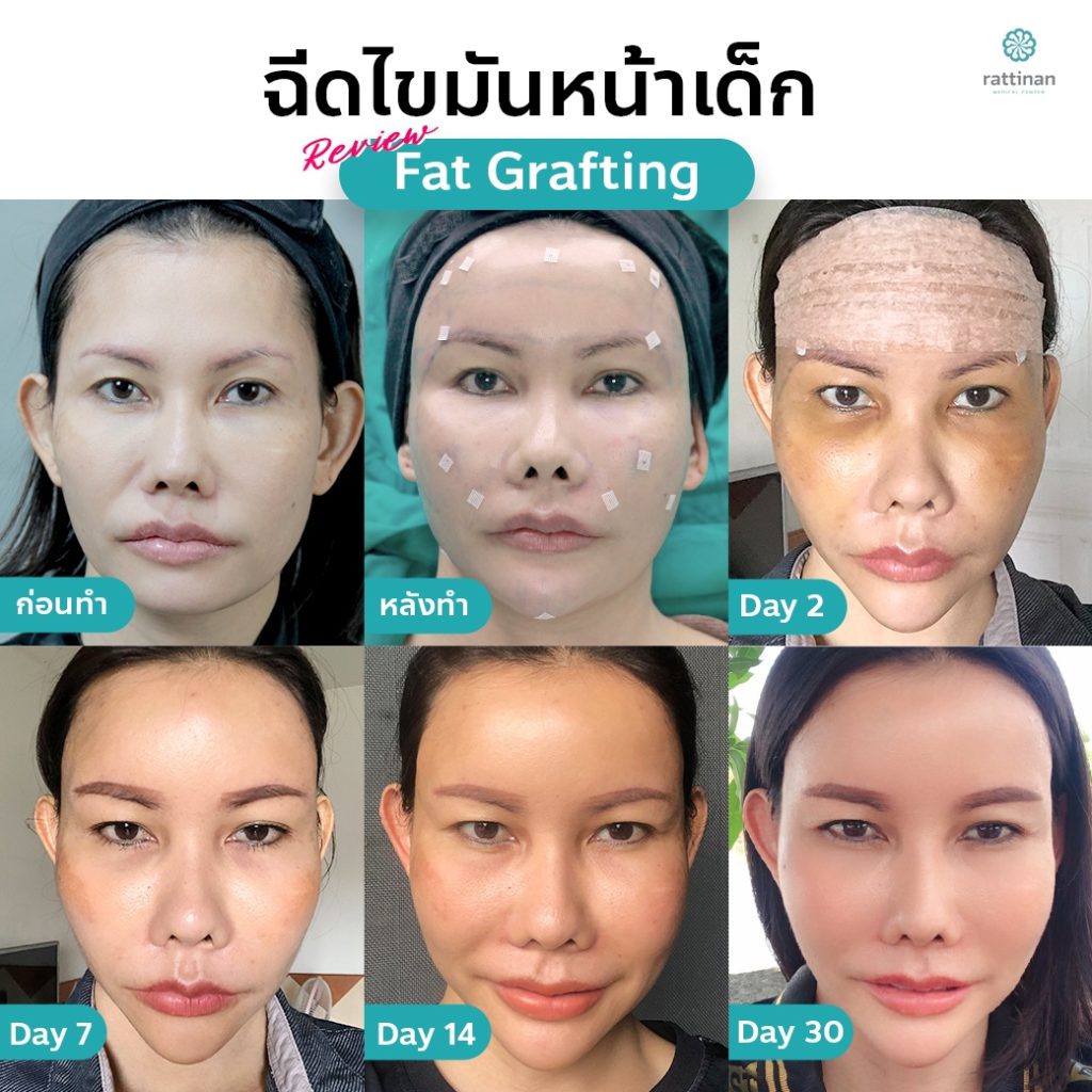 รีวิว ฉีดไขมันหน้า เติมไขมันหน้าเด็ก - fat grating