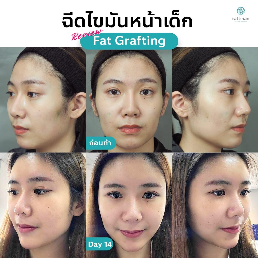 รีวิว ฉีดไขมันหน้า เติมไขมันหน้าเด็ก - fat grating