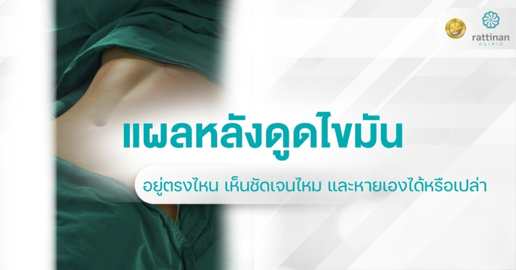 แผลดูดไขมัน