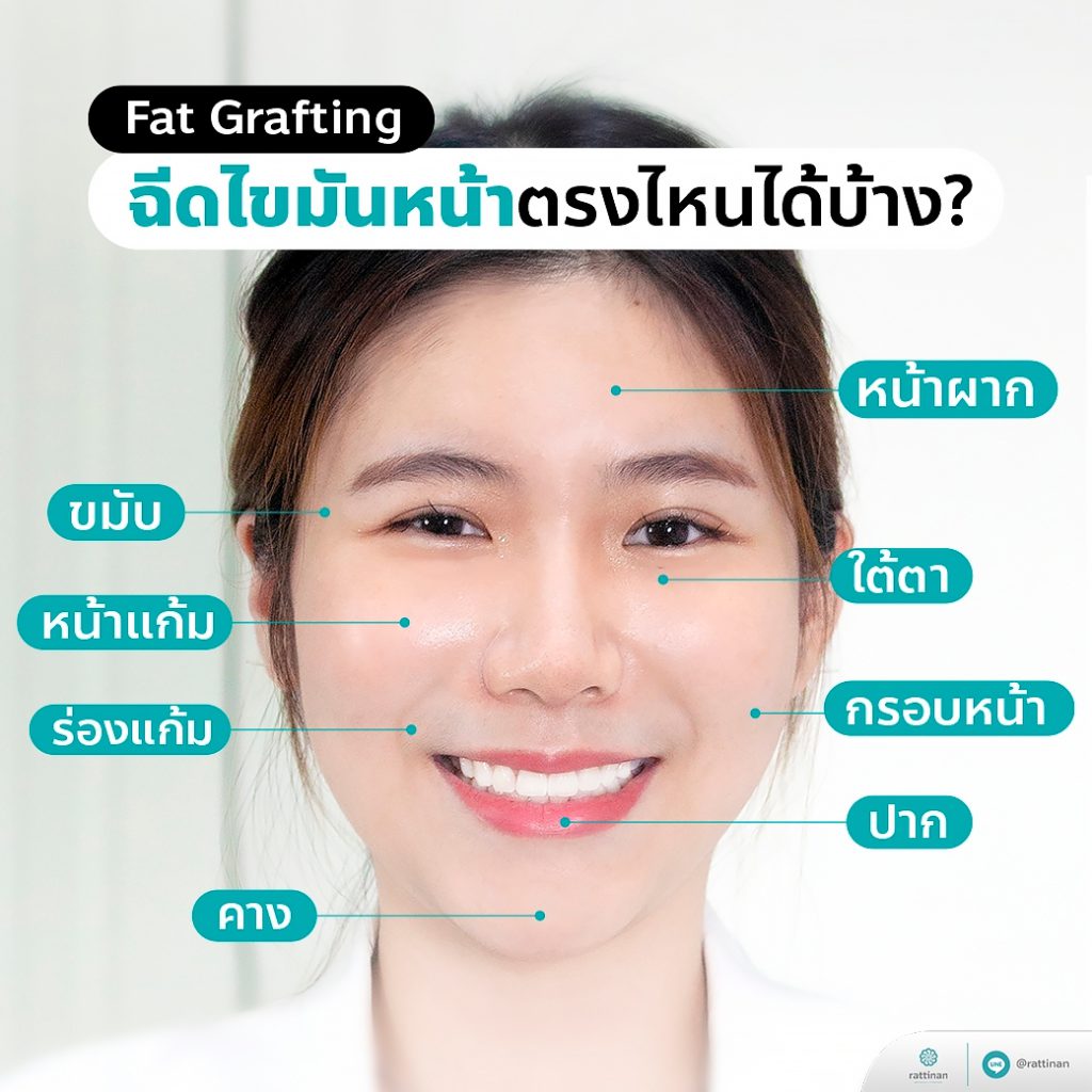 ฉีดไขมันหน้า เติมไขมันหน้าเด็กจุดไหนได้บ้าง?