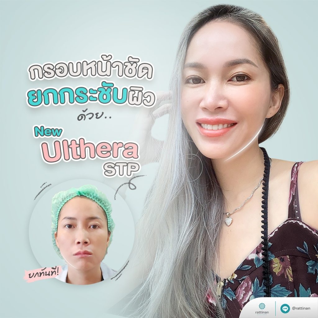 กรอบหน้าชัด ยกกระชับผิว ด้วย Ulthera