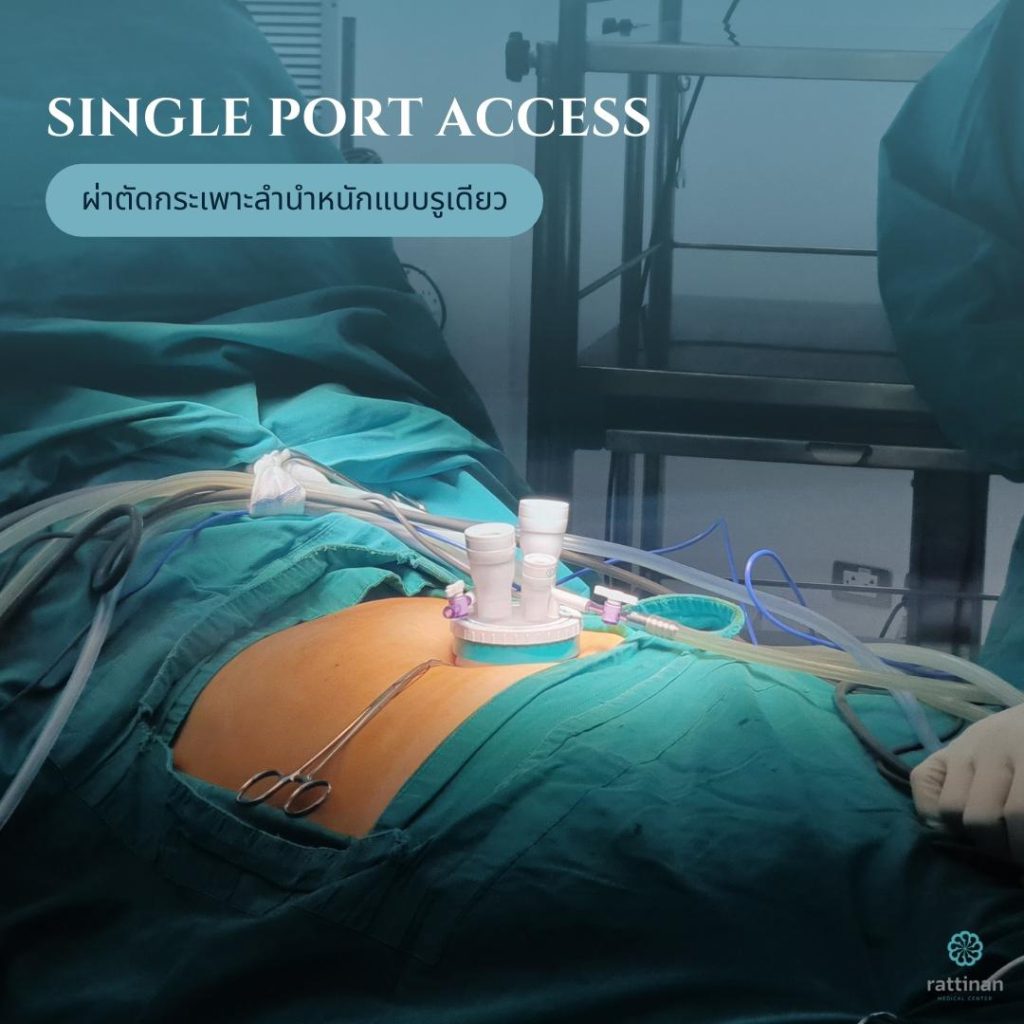 ผ่าตัดกระเพาะลดน้ำหนัก รักษาโรคอ้วน เทคนิคแผลหน้าท้องรูเดียว- Single Port Access