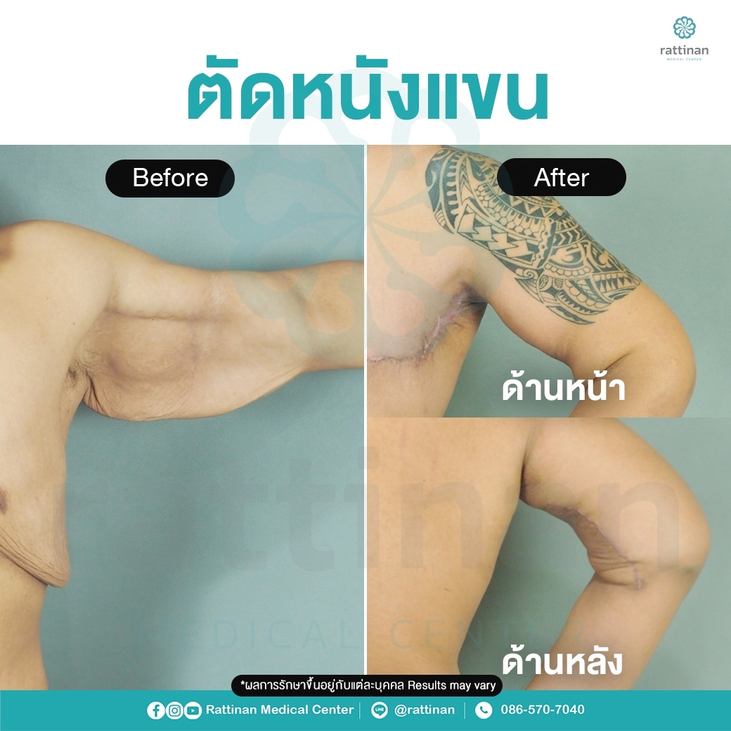 รีวิวผ่าตัดหนังแขน ผิวหนังแขนห้อย จากการลดน้ำหนัก