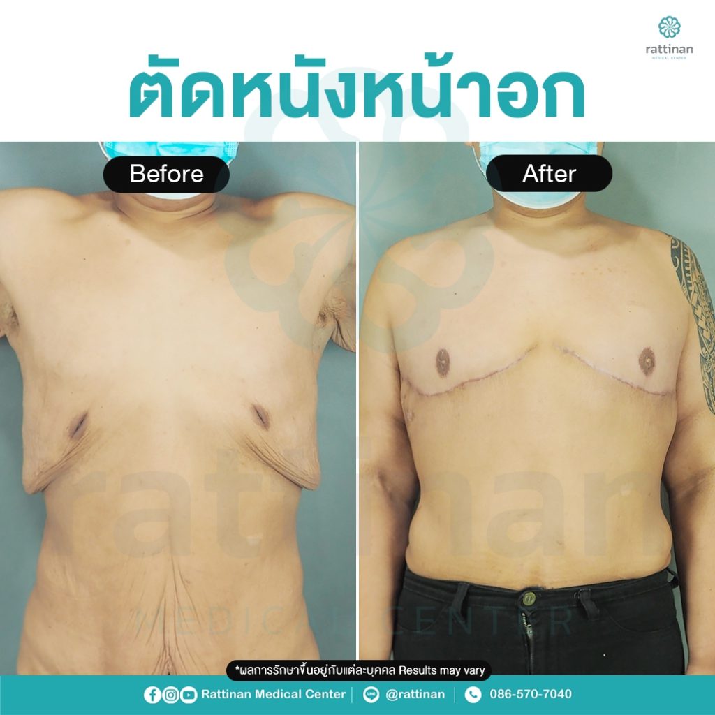 รีวิวผ่าตัดหน้าอกผู้ชาย ผิวหนังเหี่ยวจากการลดน้ำหนัก