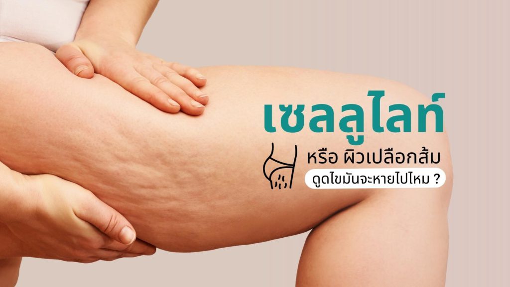 เซลลูไลท์ (Cellulite) คืออะไร