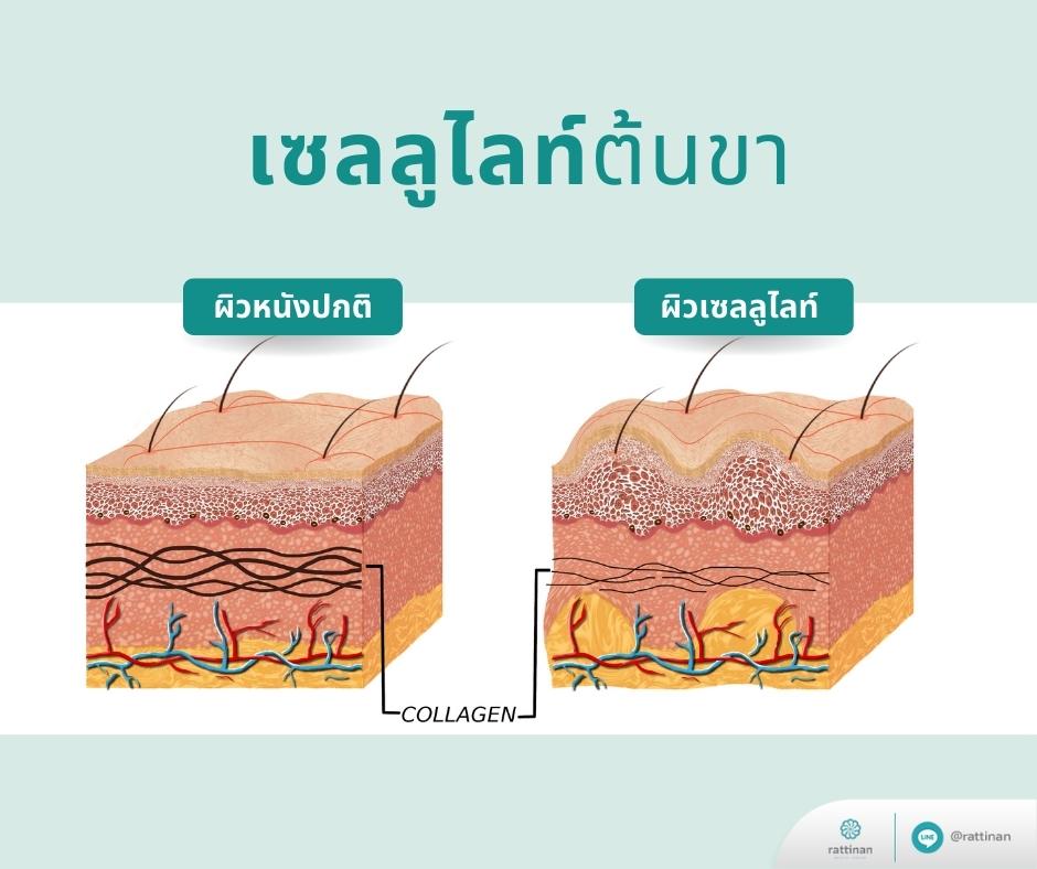 ลักษณะเซลลูไลท์ต้นขา วิธีลดเซลลูไลท์ต้นขา