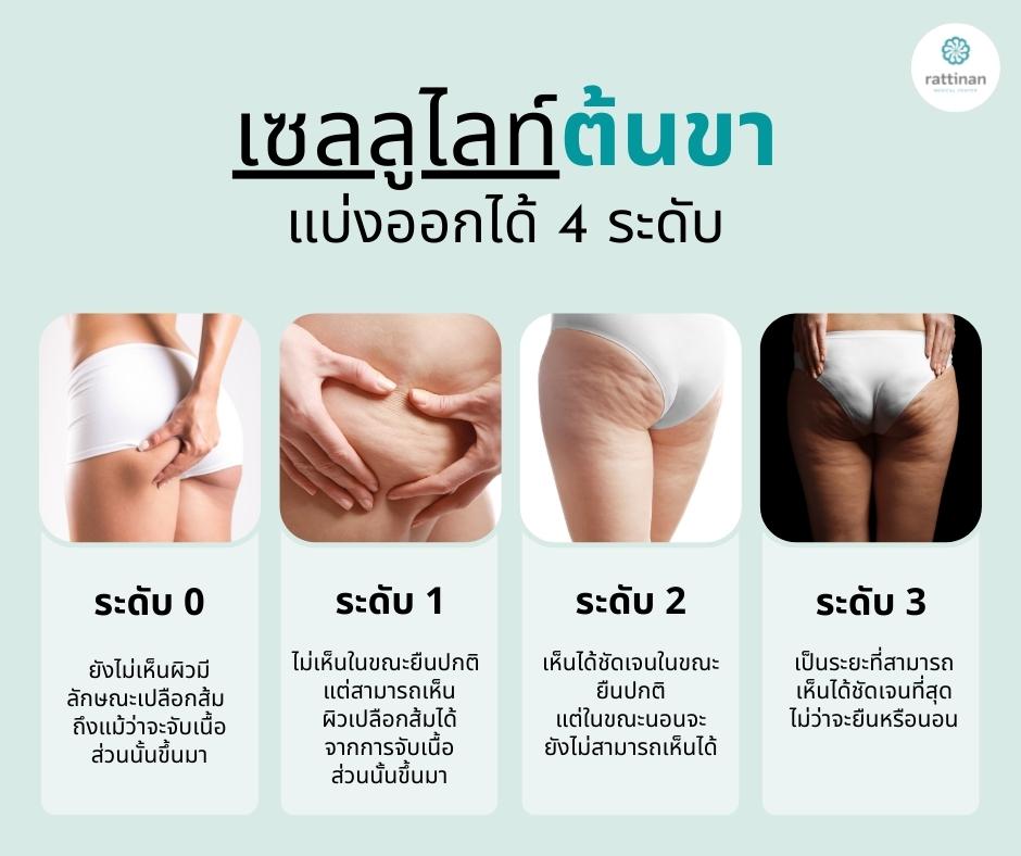 เซลลูไลท์ต้นขา มีกี่แบบ? วิธีลดเซลลูไลท์ต้นขา