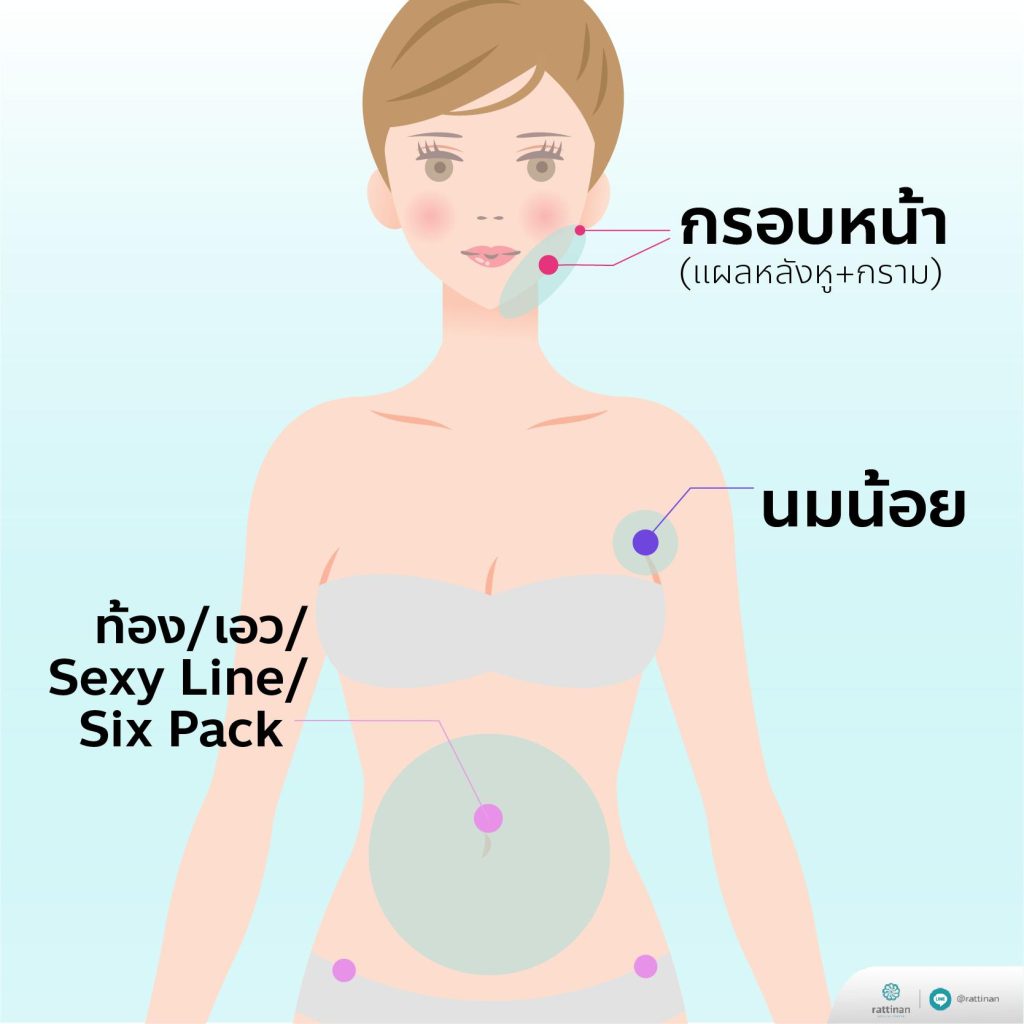 ตำแหน่งแผลดูดไขมัน อยู่ตรงไหน?