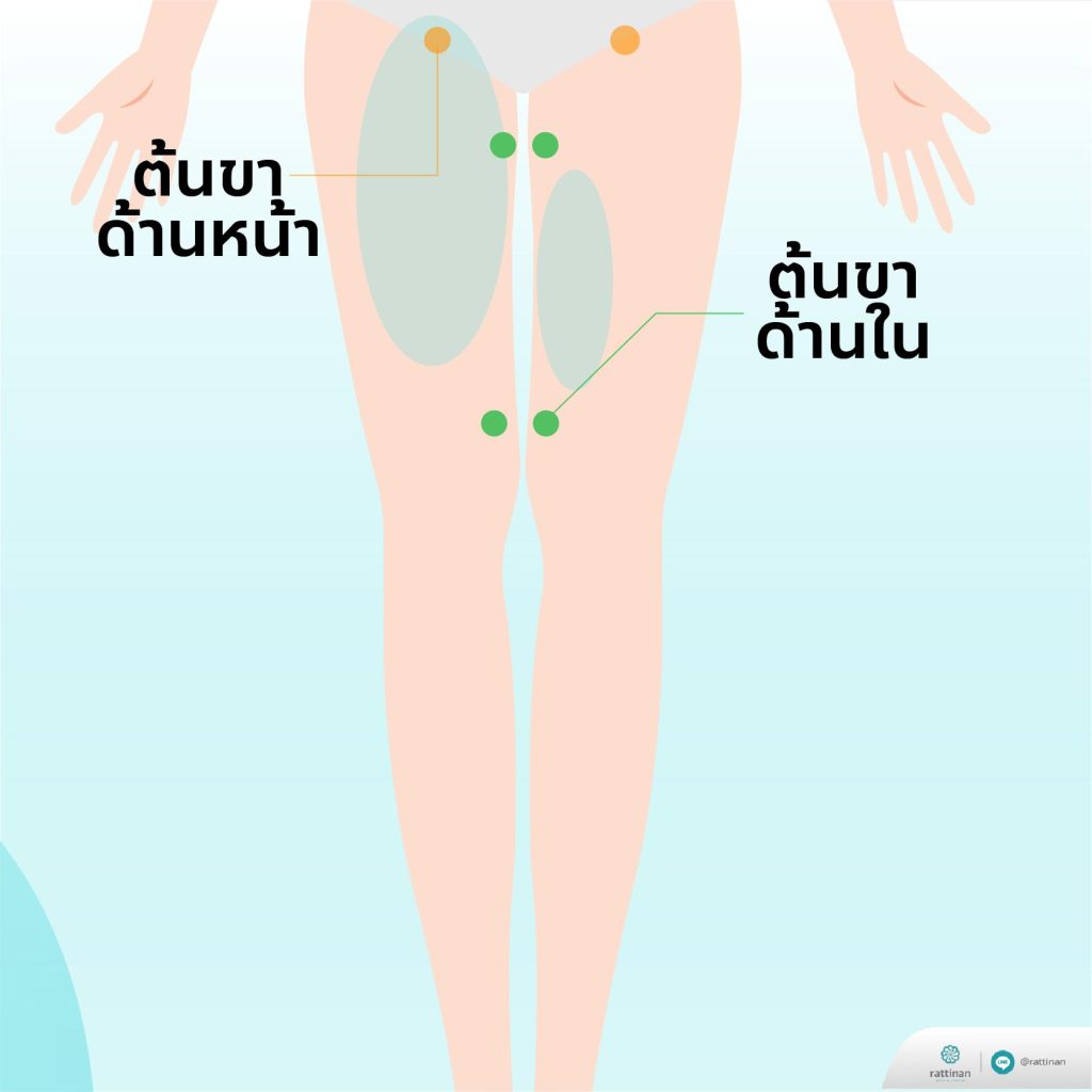 ตำแหน่งแผลดูดไขมัน อยู่ตรงไหน?