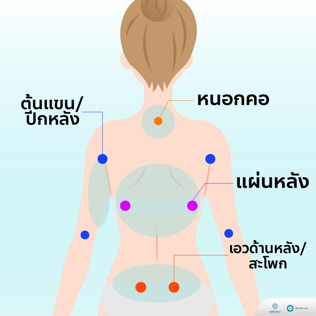 ตำแหน่งแผลดูดไขมัน อยู่ตรงไหน?