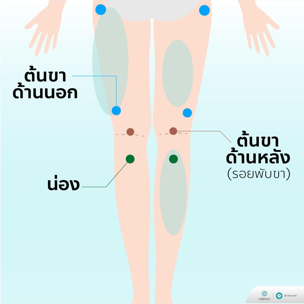 ตำแหน่งแผลดูดไขมัน อยู่ตรงไหน?