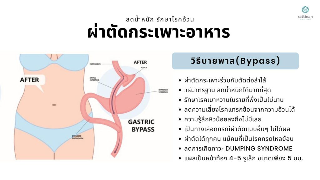 ข้อดี ผ่าตัดกระเพาะลดน้ำหนักแบบบายพาส (Gastric Bypass) วิธีมาตรฐานรักษาโรคอ้วน