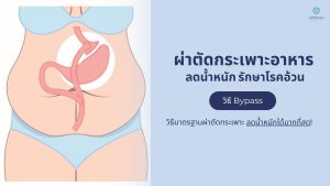 ผ่าตัดกระเพาะลดน้ำหนักแบบบายพาส (Gastric Bypass) วิธีมาตรฐานรักษาโรคอ้วน