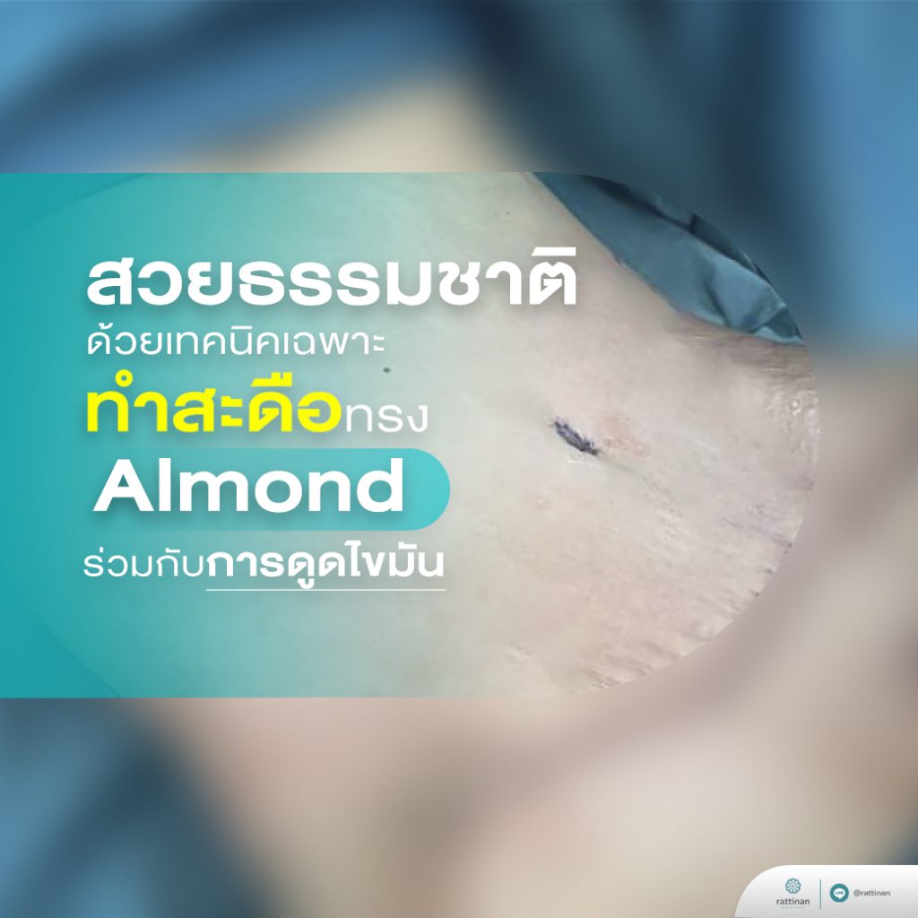 เทคนิคเย็บสะดือ almond shape เฉพาะที่รัตตินันท์ เมดิคอล เซ็นเตอร์