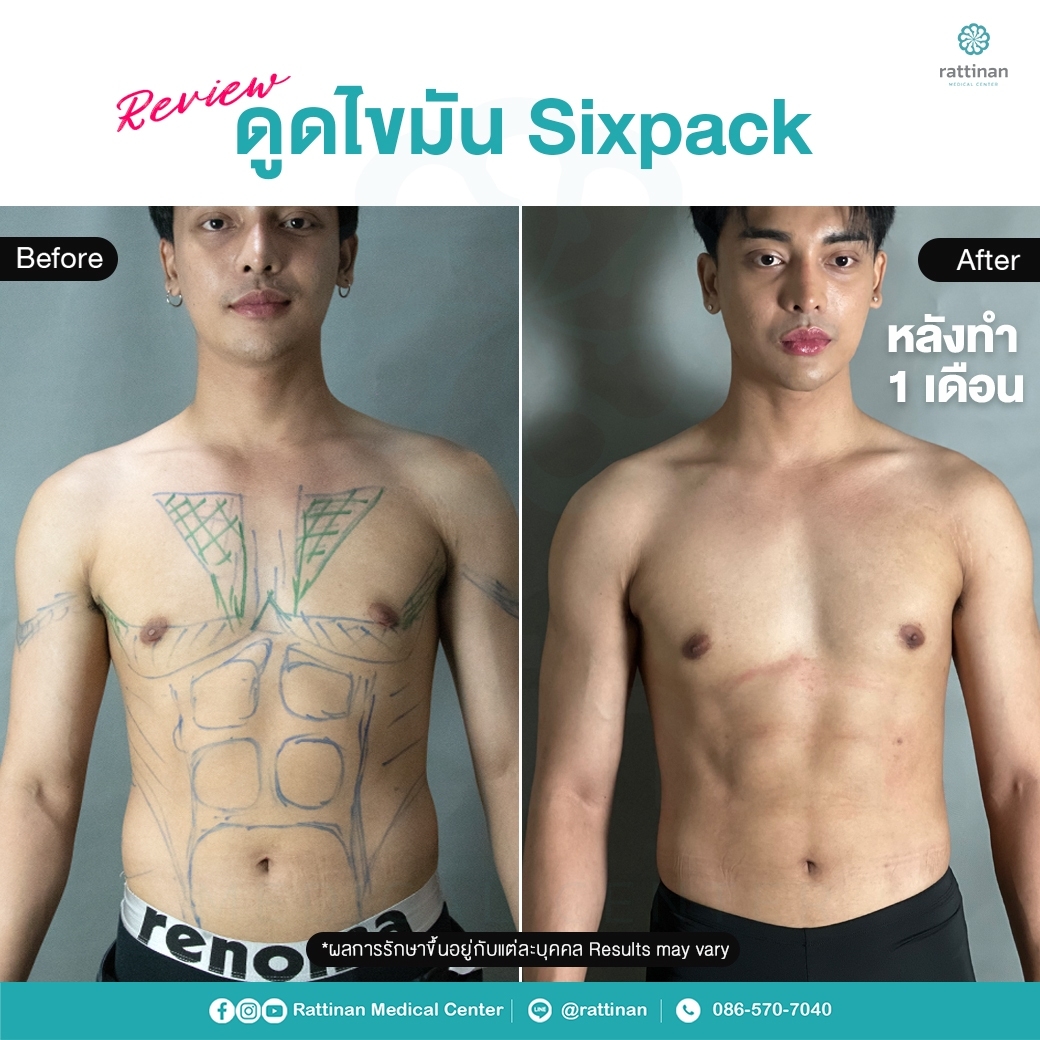 six pack liposuction ดูดไขมันซิกแพค